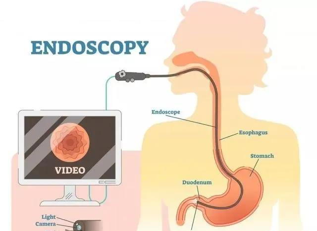 为什么说胃肠镜是救命的检查？90%的疾病都集中在消化道！